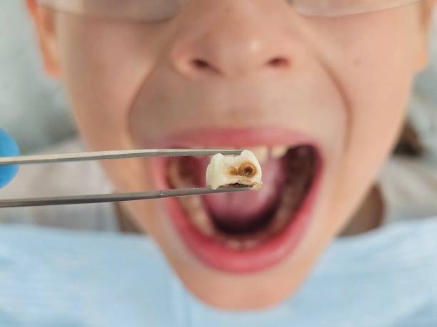 Best Broken or Chipped Tooth Repair in East Dundee, IL